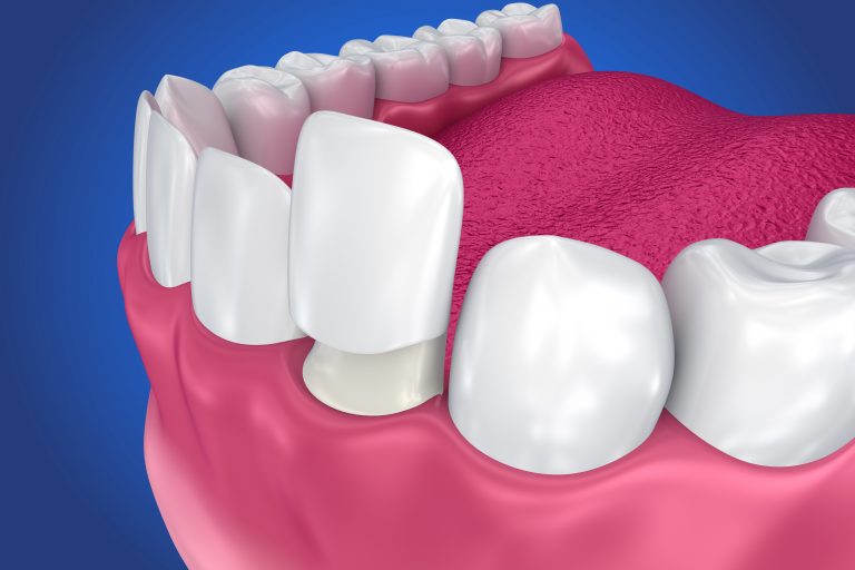 Dental Veneers: Porcelain Veneer Installation Procedure. 3d Illustration