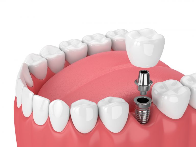3d Render Of Jaw With Teeth And Dental Molar Implant